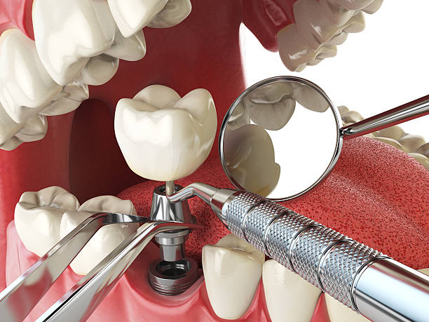 Best Emergency Root Canal Treatment in Weedpatch, CA